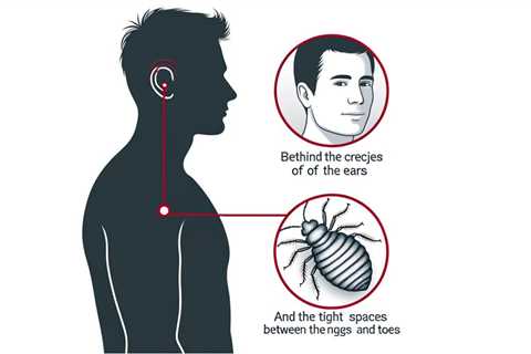 Where Do Bed Bugs Hide on Your Body?